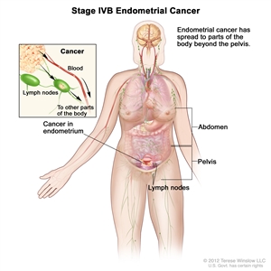 Endometrial cancer patient facts